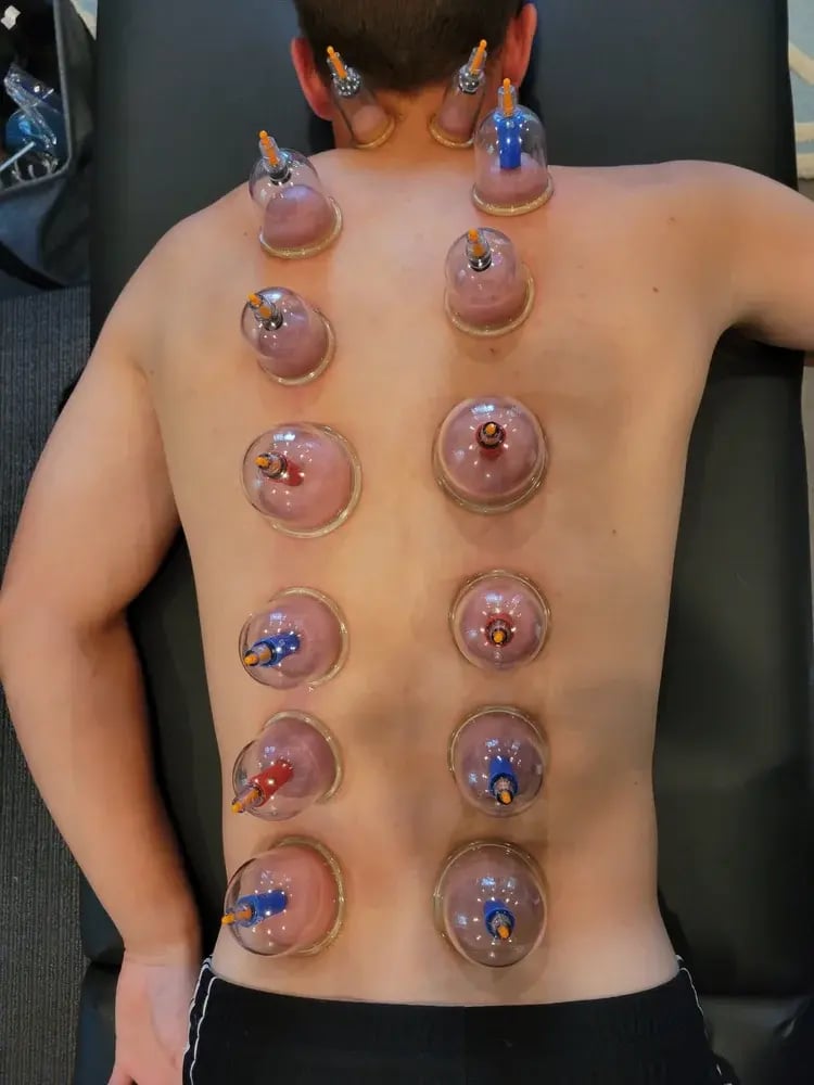 Dry Needling and Hands on techniques