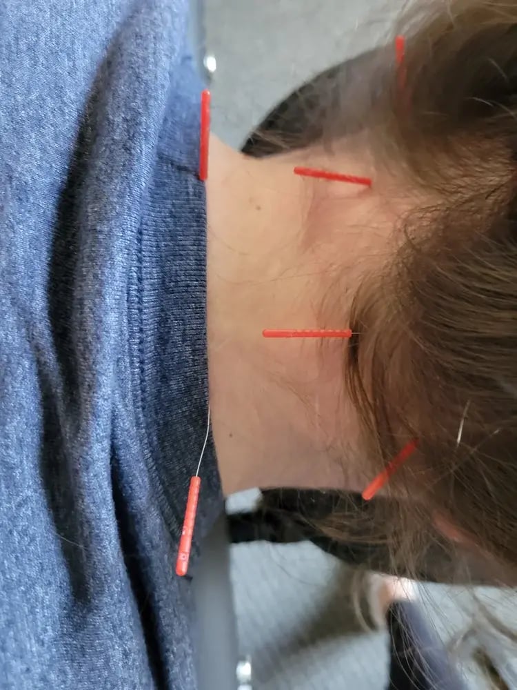 Dry Needling Physical Therapy